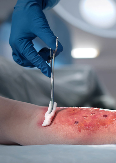 Understanding Skin Burns